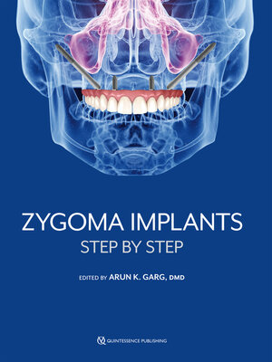 cover image of Zygoma Implants